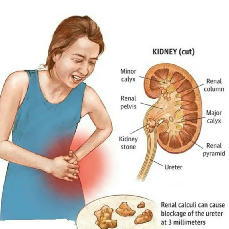 خرید آنلاین داروی سنگ کلیه رویال