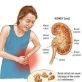پکیج دفع سنگ کلیه رویال